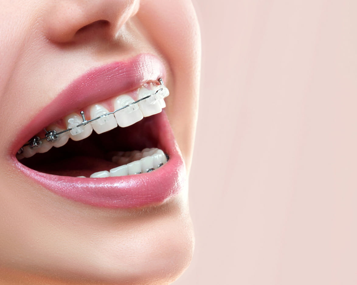 Traditional braces