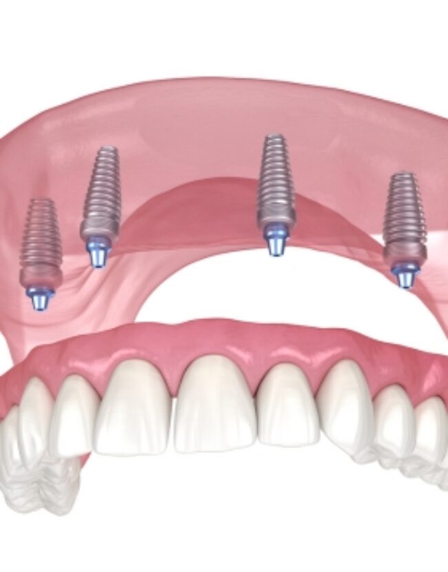 Full arch implants