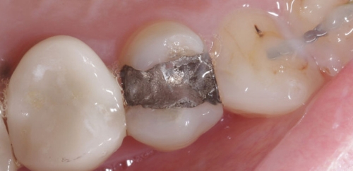 Aesthetic restoration before