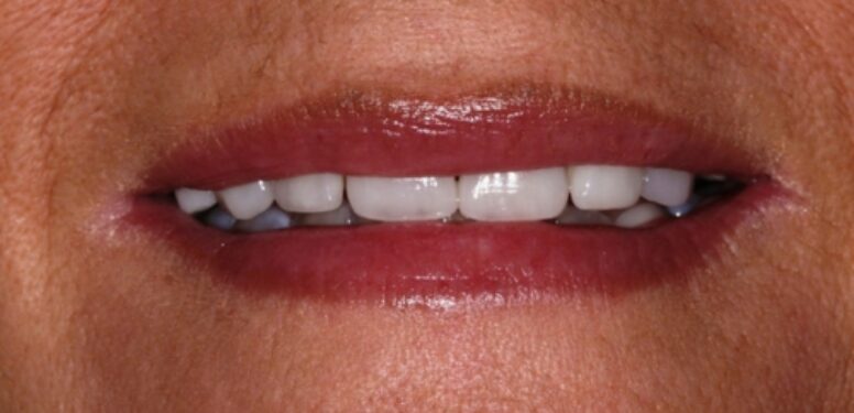 Smiledesign with Orthodontics after