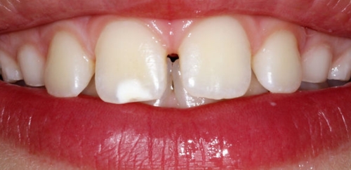 Icon remineralisation after