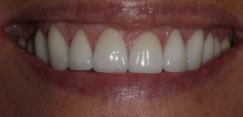 Smiledesign with Veneers after