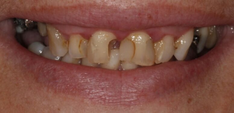 Smiledesign with Crowns before