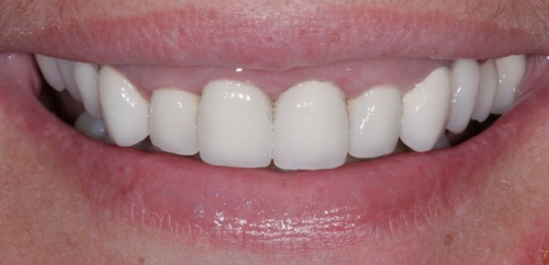 Smiledesign with Crowns after