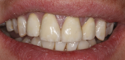 Smile Rehabilitation after