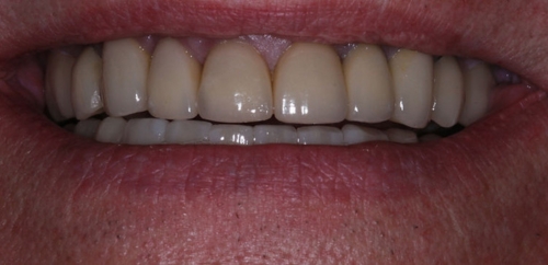 Full Mouth Rehabilitation after