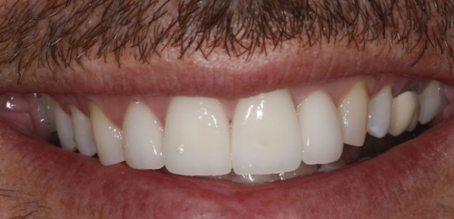 Mini Smiledesign after