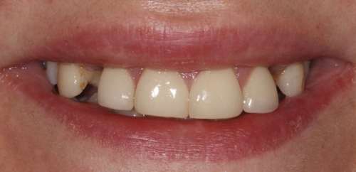 Smiledesign with Implants before