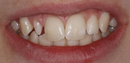 Single Tooth Veneer on Upper Right Lateral Tooth before